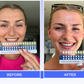 Irresistible Smile | At-Home Teeth Whitening Kit