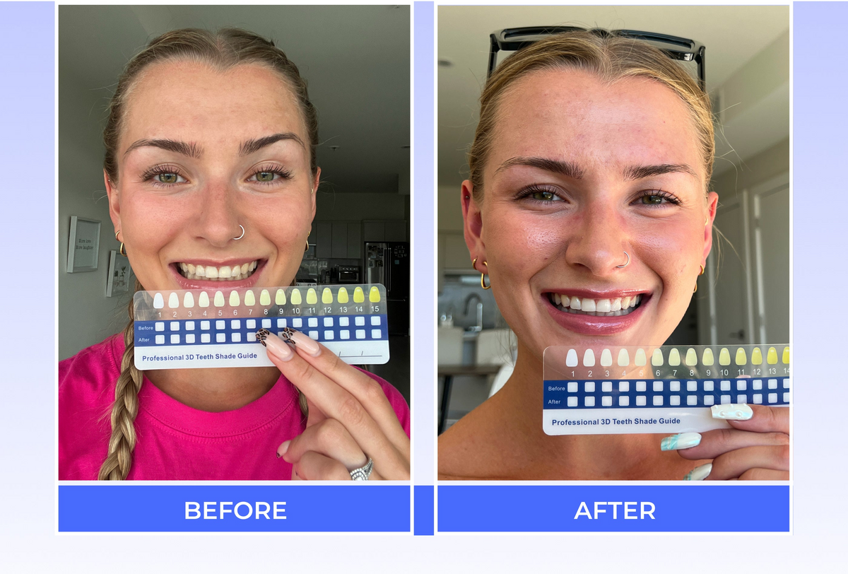Irresistible Smile | At-Home Teeth Whitening Kit