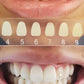 SUGAR Wireless Dentist-Developed Whitening Kit – Advanced whitening technology for a radiant smile
